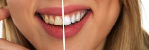 How to Stop Yellowing of Teeth at Home? ﻿